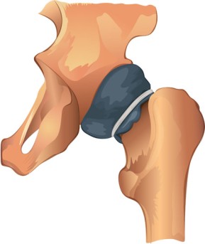 Chiari Osteotomy by OrangeCountySurgeons